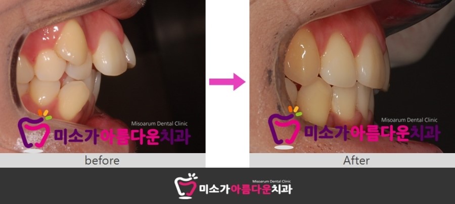 세라믹교정 덧니교정 세라믹치과에서 ~~ 관련 이미지 3