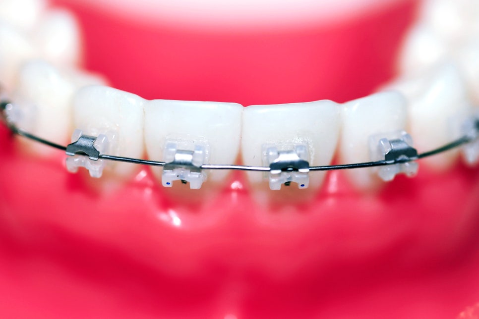 클리피씨 교정 월17만에 ~ 관련 이미지 3