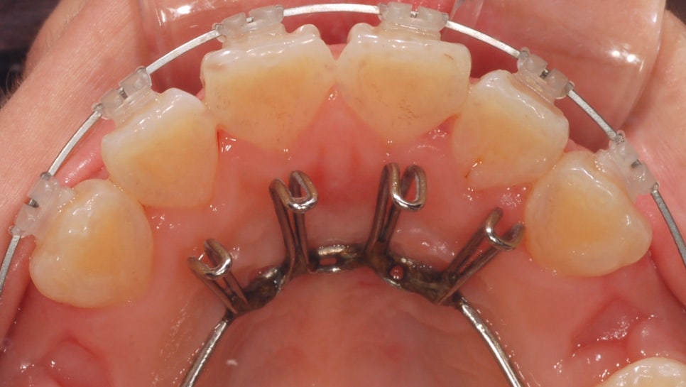 개방교합은 재발률이 높다? 치아교정 후 관리방법 (feat.유지장치) 관련 이미지 8