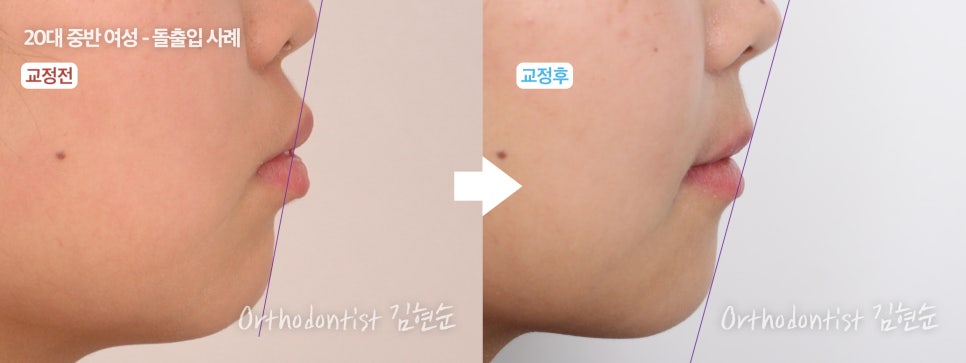 학동역치과 치아교정은 여기서 !! 관련 이미지 22