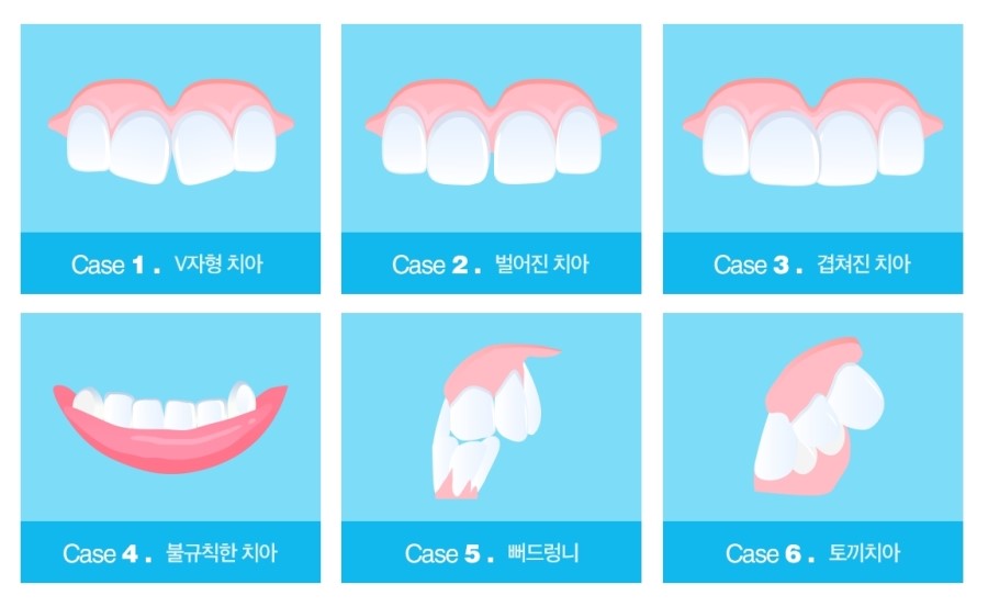 세라믹치과 앞니부분교정 관련 이미지 4