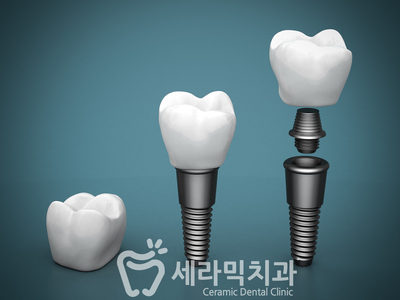 임플란트 건강보험으로 씹는 즐거움을! 관련 이미지 1