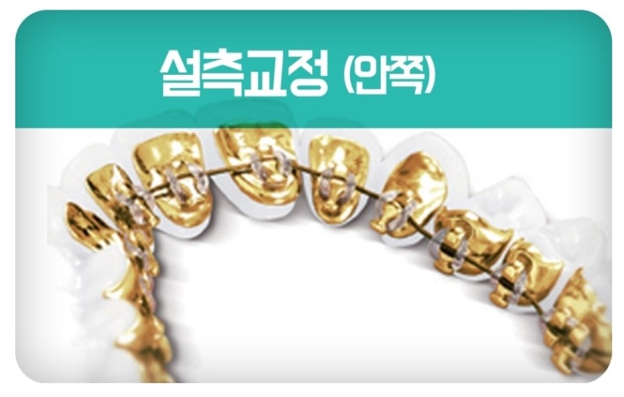 세라믹교정 클리피씨 데이몬 차이점 요약 관련 이미지 15