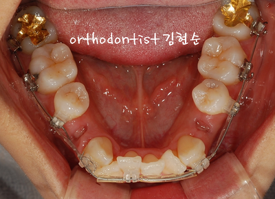 강남 덧니 관련 이미지 19