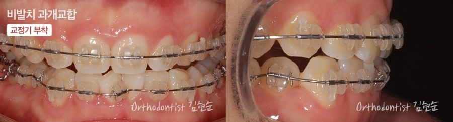 과개교합 무턱 개선 관련 이미지 10