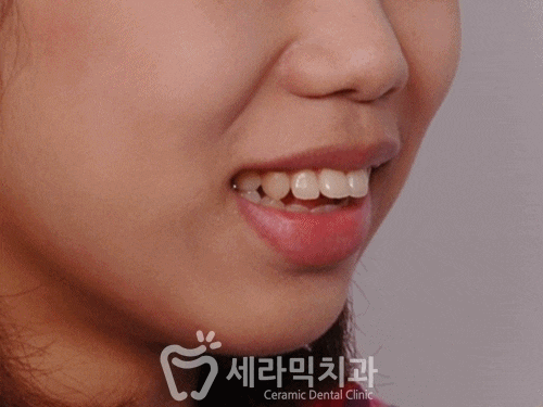 치아교정전후 영상. 돌출입과 개방교합 치아교정 전후 관련 이미지 2