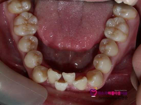 학동역치아교정잘하는치과 미소가아름다운치과 덧니교정 과정 관련 이미지 6
