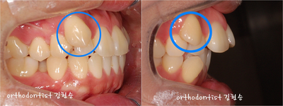 덧니교정 잘하는 학동역 교정치과, 세라믹치과 관련 이미지 2