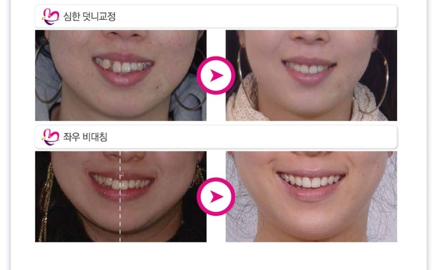 [ 학동역 치과 ] 투명교정의 새이름 3D miso 교정 관련 이미지 12