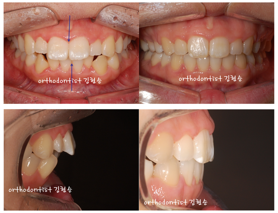 미니스크류, 돌출입 발치 교정 잇몸노출 개선 관련 이미지 12