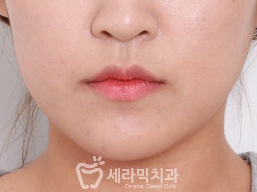돌출입교정으로 갸름한 턱라인까지 되찾다! 돌출입 치아교정전후 관련 이미지 16