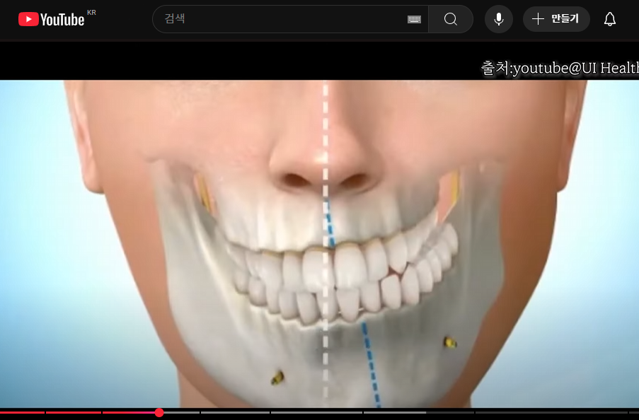 앞니 중심선 안맞으면, 안면비대칭인가요? [치아교정 필요한 예시] 관련 이미지 4