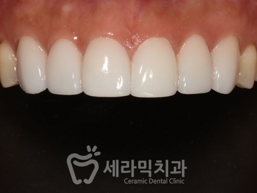 무삭제 라미네이트라면서? 대체 얼마나 삭제하는거죠? 관련 이미지 6