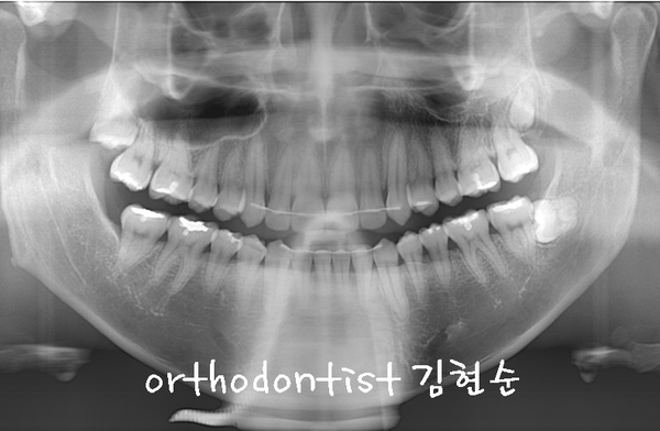 반대교합 관련 이미지 26