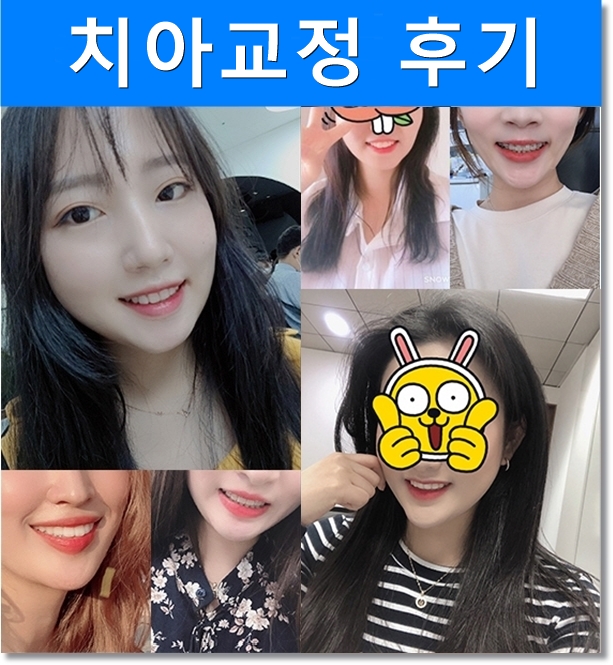 돌출입, 치열불규칙, 치아상실 치아교정과 임플란트 전후 관련 이미지 11