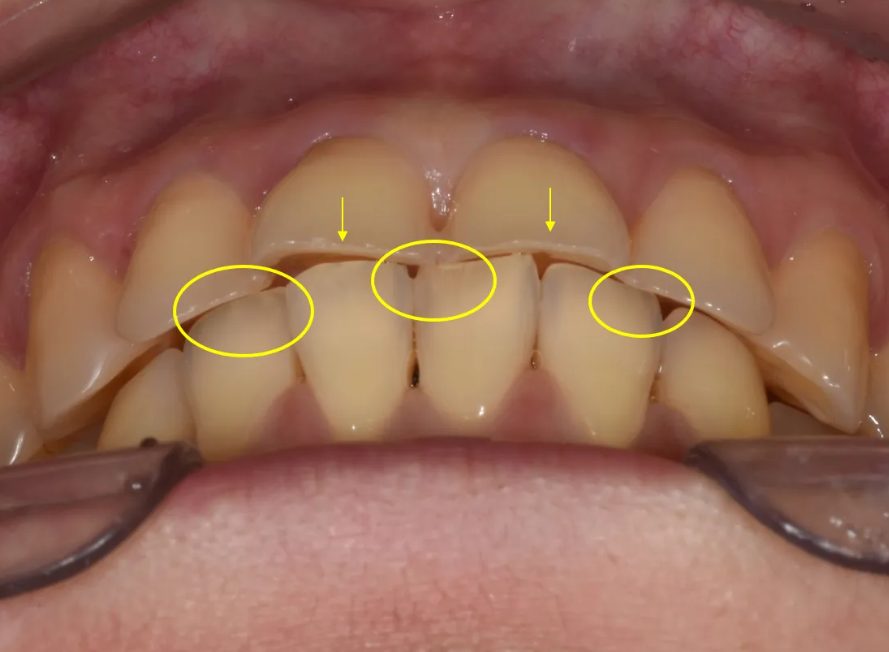 학동역 라미네이트 전후, 치아 모양과 색상 개선 사례 관련 이미지 5