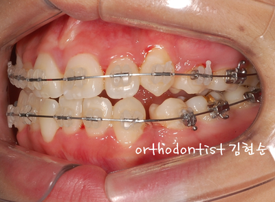 강남 덧니 관련 이미지 23