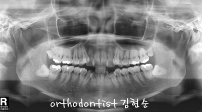 강남 덧니 관련 이미지 6