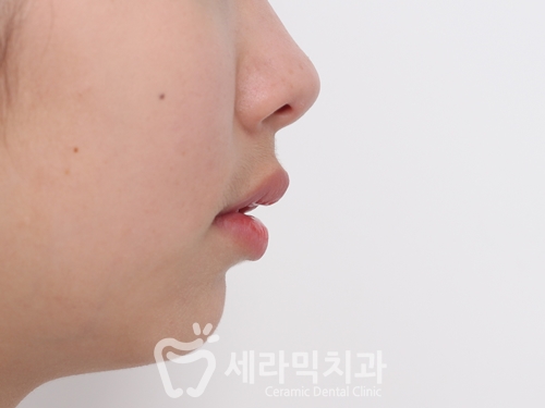 돌출입교정, 심미성과 치아 건강을 동시에 해결! 관련 이미지 12