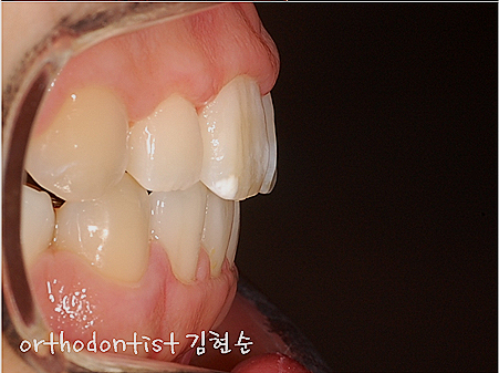 강남 돌출입 교정 관련 이미지 36