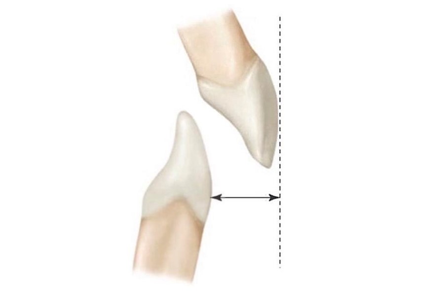 학동역치과 돌출입교정은 세라믹치과에서 관련 이미지 5