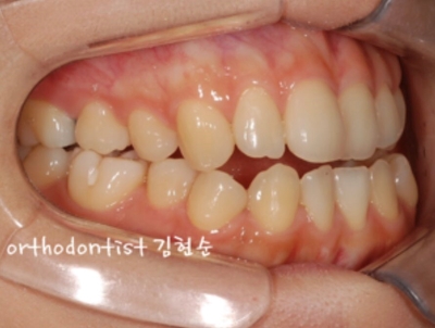 강남교정치과 관련 이미지 5