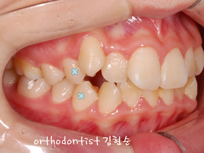 강남 돌출 (토끼 치아) 관련 이미지 16
