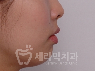 돌출입 덧니 비대칭 치아교정 전후 인상변화! 관련 이미지 10