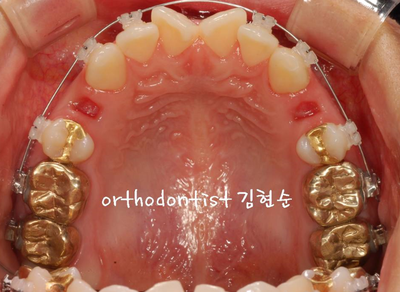 강남 돌출입 교정 관련 이미지 15