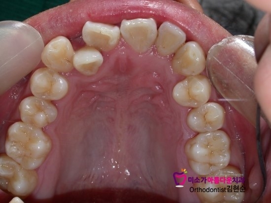 학동역치아교정잘하는치과 미소가아름다운치과 덧니교정 과정 관련 이미지 4
