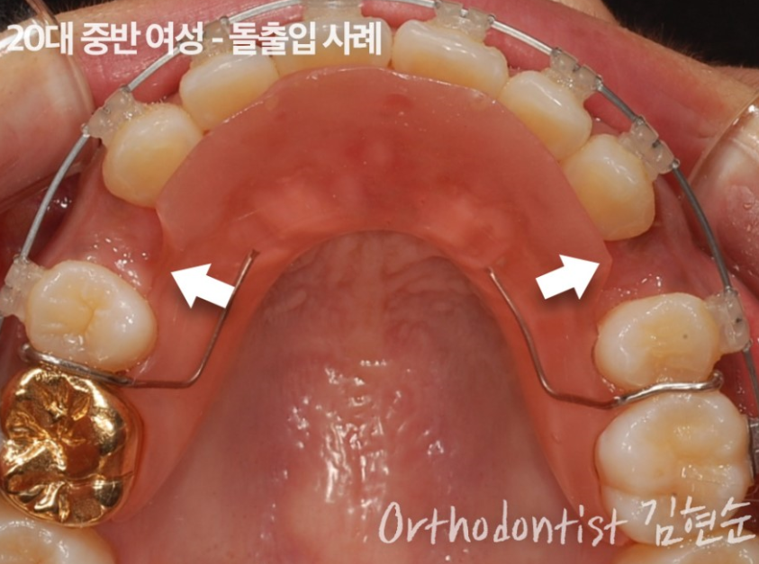 학동역치과 세라믹치과 교정리얼스토리 관련 이미지 4