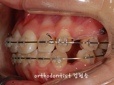 강남 돌출 (토끼 치아) 관련 이미지 25