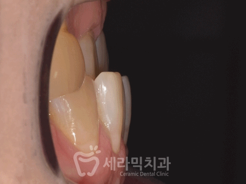 40대에 이어 50대 치아교정 전후사례 증가 추세 관련 이미지 13