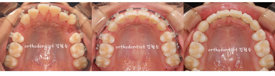 세라믹교정 은 세라믹치과 수술없이 돌출개선 관련 이미지 6