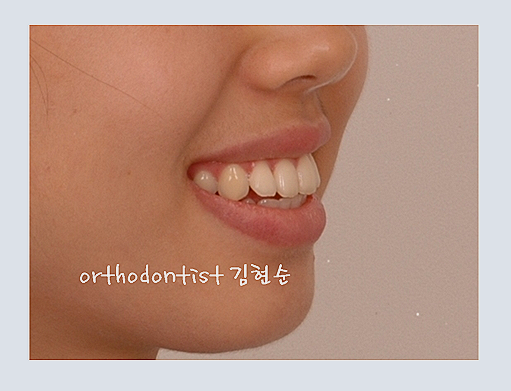 강남교정치과 관련 이미지 6