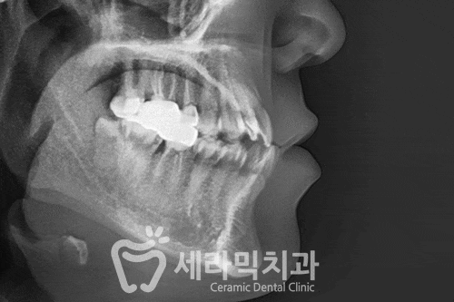 반대교합과 아래 돌출입 치아교정전후 관련 이미지 7