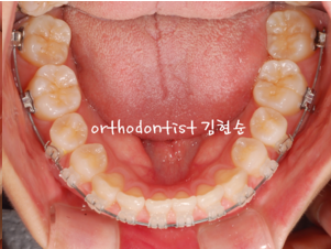 강남 돌출입 교정 관련 이미지 22