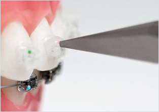 데이몬클리어 vs 클리피씨교정 관련 이미지 10