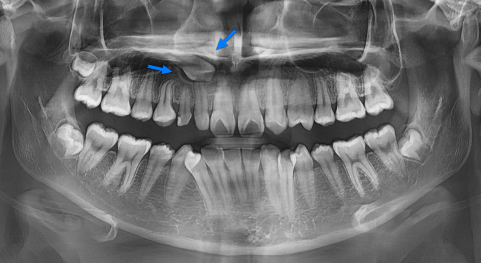 왜소치, 결손치가 동시에 있었던 환자의 앞니 심미보철 관련 이미지 5