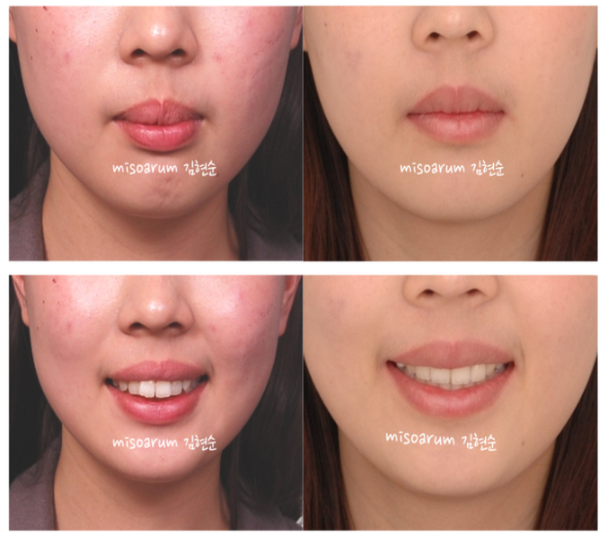 강남 돌출입 관련 이미지 10