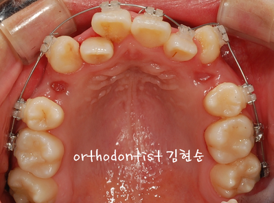 강남 덧니 관련 이미지 15