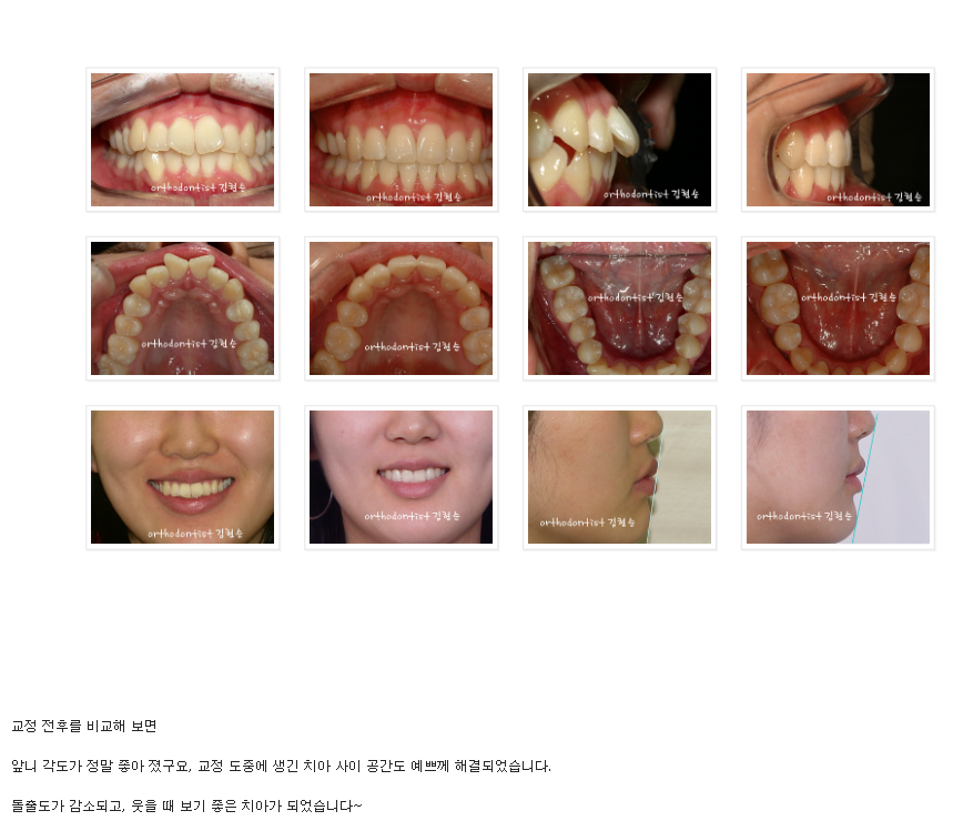 앞니가 돌출된 경우, 발치 교정 후 블랙 트라이앵글(치아 사이 공간) 삭제 관련 이미지 6