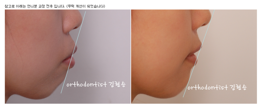세라믹교정 세라믹치과-돌출입 발치교정 11 관련 이미지 6