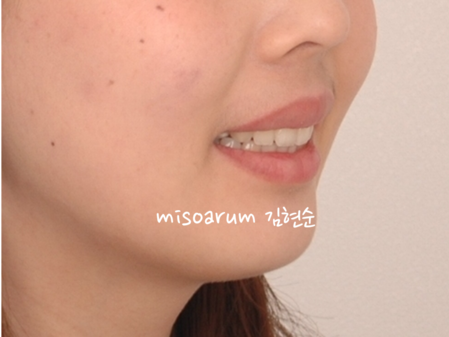 강남 돌출입 교정 관련 이미지 37