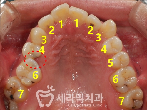 세라믹치과 치아교정전후 : 앞니반대교합+치열불규칙 관련 이미지 5