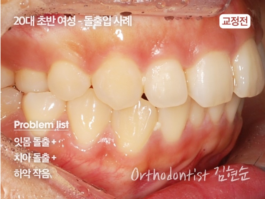 클리피씨교정 기간 짧을까? 관련 이미지 14