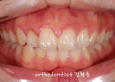 강남 돌출 관련 이미지 18