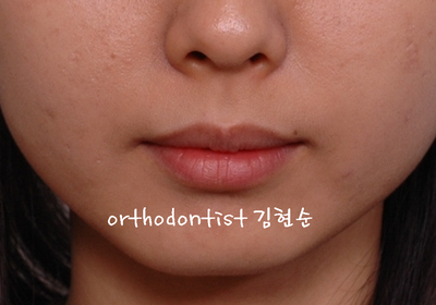 돌출 교정 (비발치 교정/비대칭) 관련 이미지 9