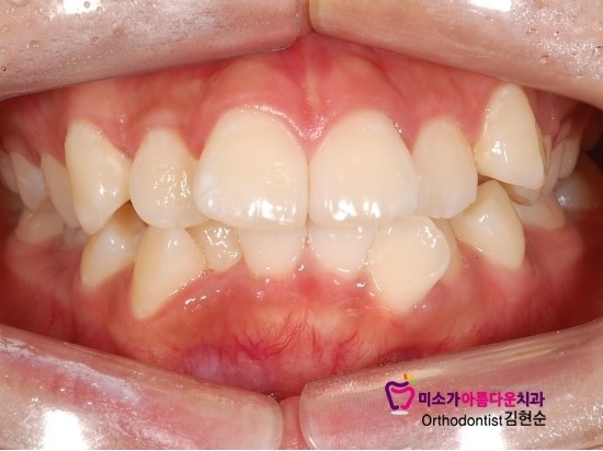 논현동교정잘하는치과 미소가아름다운치과 고객님 후기입니다 관련 이미지 1