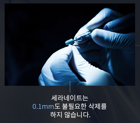 벌어진 앞니, 최소삭제 라미네이트 전후 관련 이미지 1